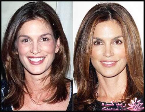 جراحی بینی - جراحی زیبایی